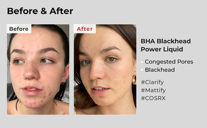 COSRX BHA Blackhead Power Liquid from COSRX